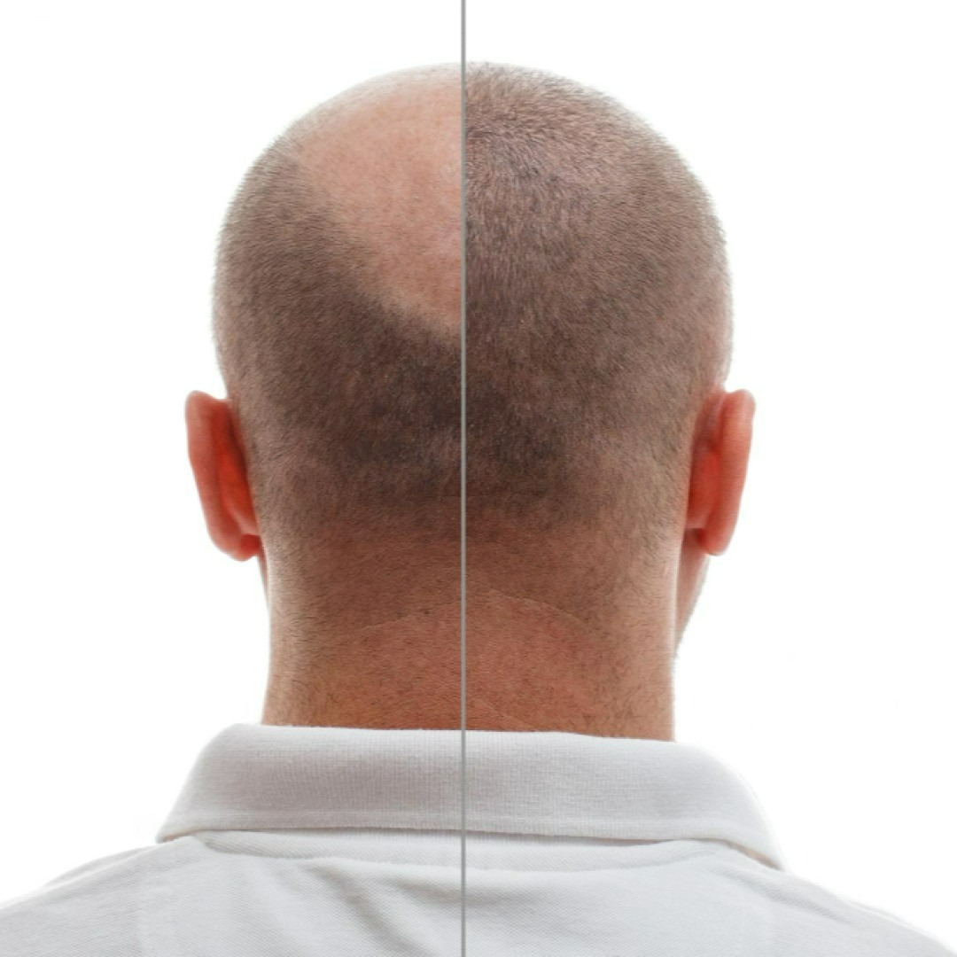 The Evolution of Hair Transplantation: Past, Present, and Future