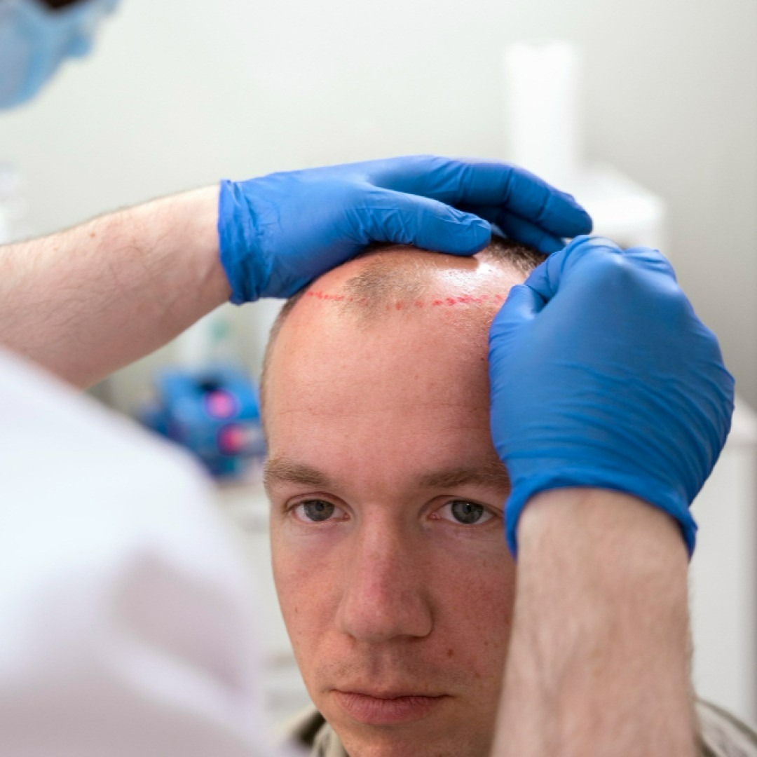 FUE vs. FUT: Which Hair Transplant Method is Right for You?