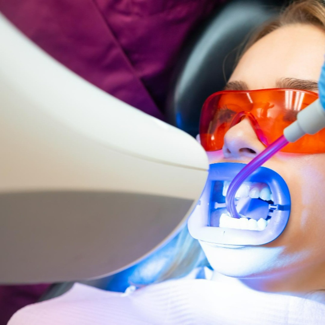 The Benefits of Professional Teeth Whitening