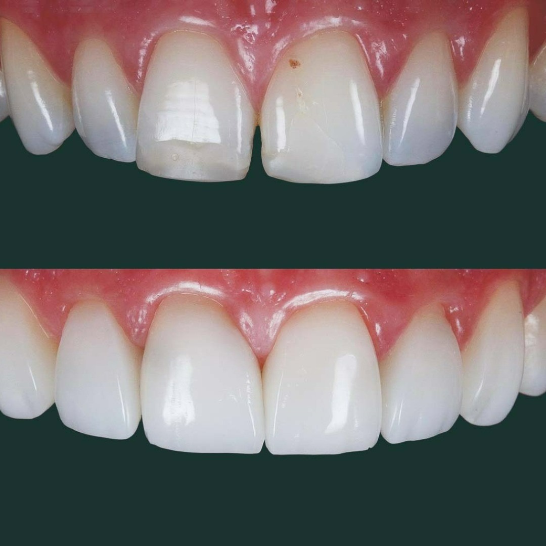 Composite Bonding: An Affordable Solution for a Perfect Smile