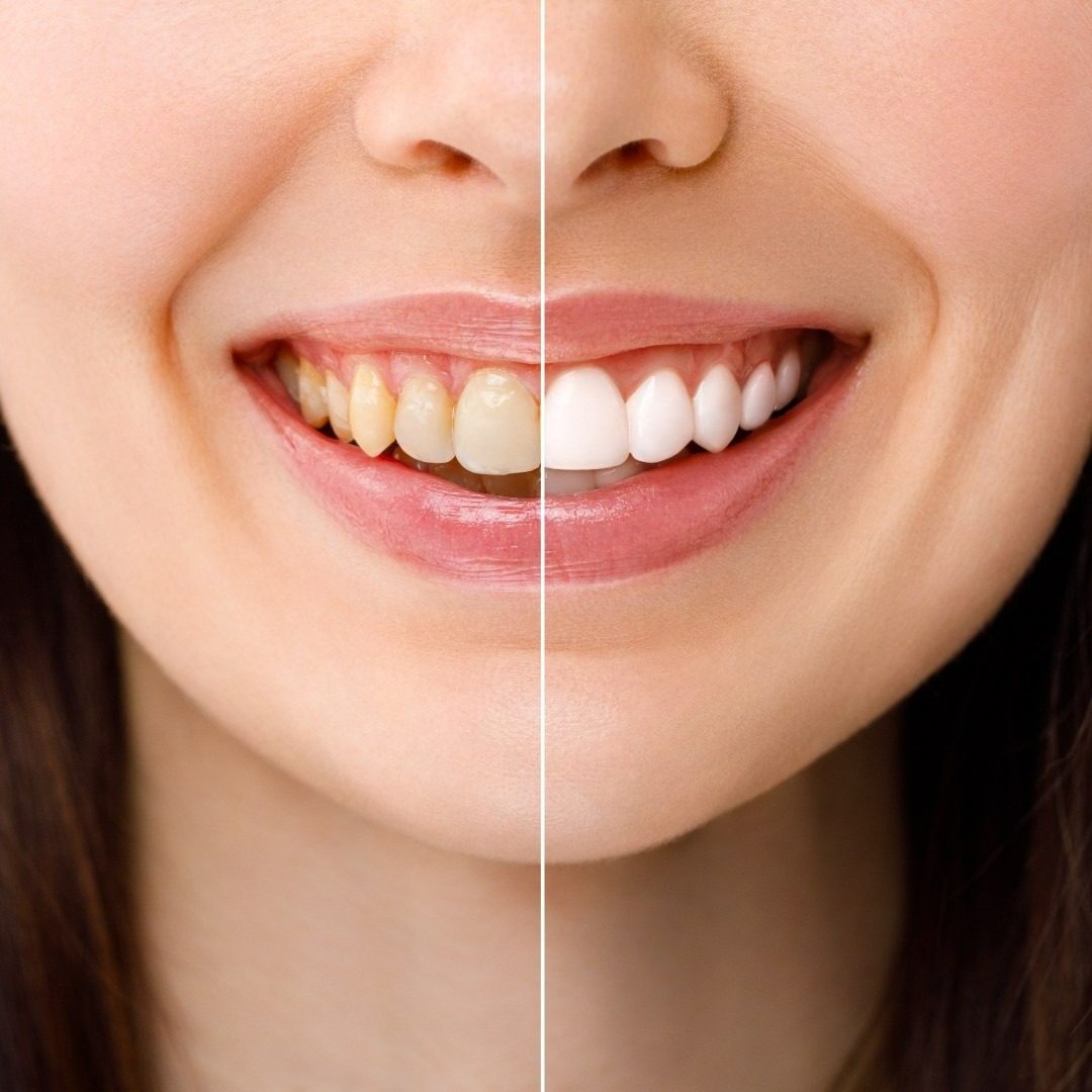 Teeth Whitening Options