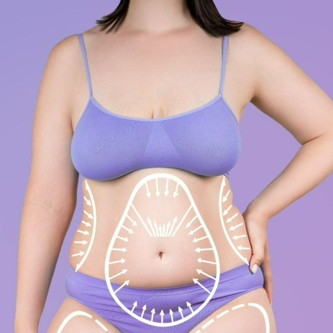 Abdominoplasty